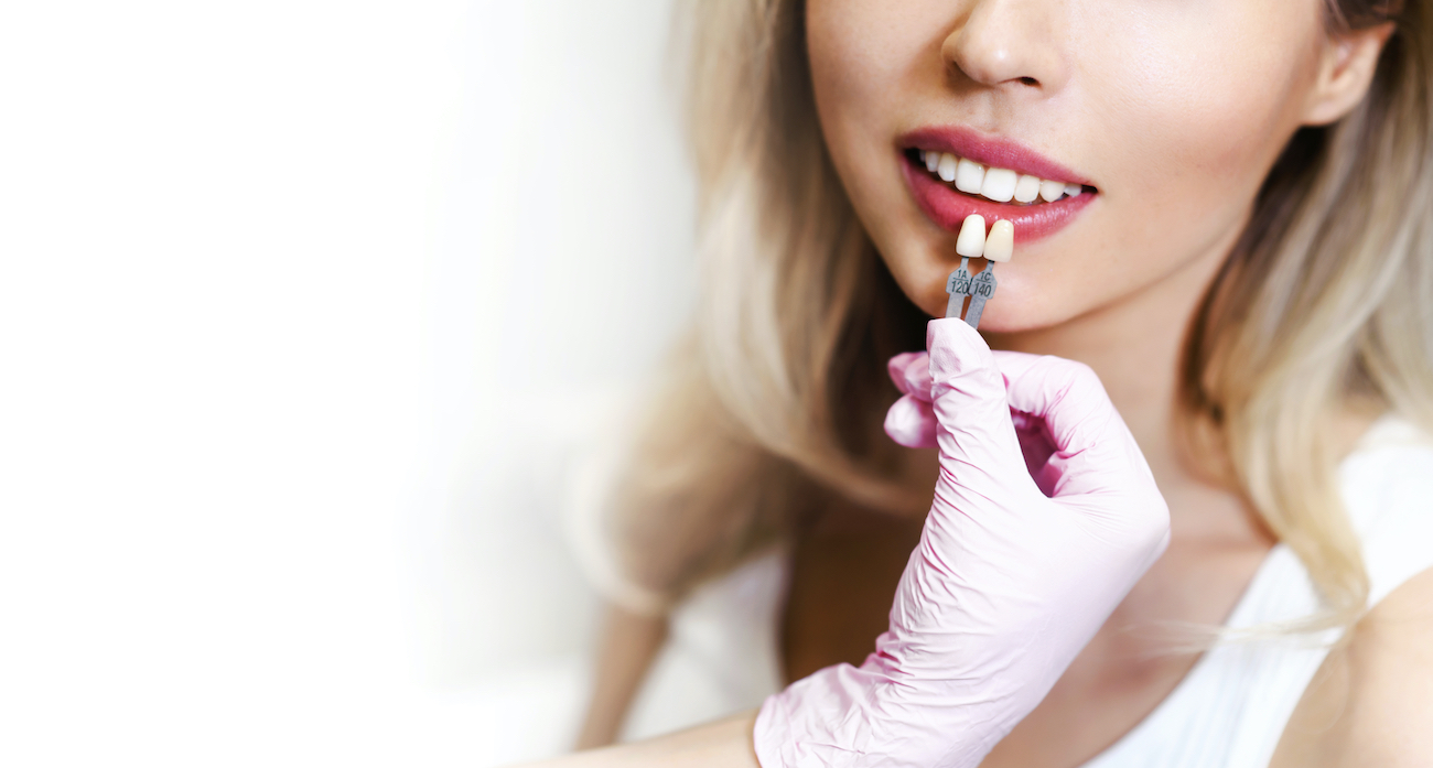 Dental Veneers in Southwest Houston: What Are They and Why Might You Need Them?